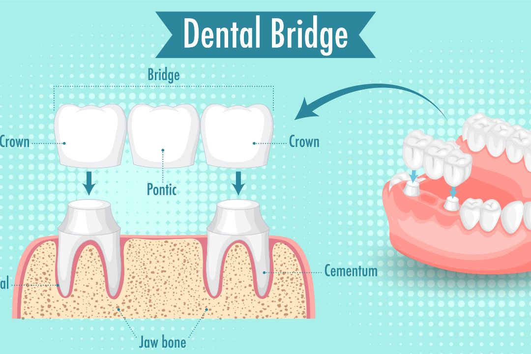 dental bridges